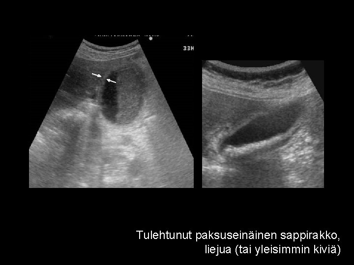 Tulehtunut paksuseinäinen sappirakko, liejua (tai yleisimmin kiviä) 