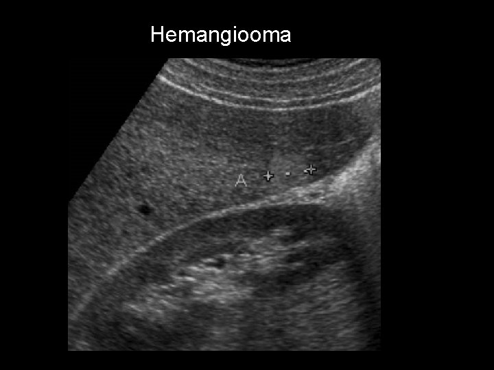 Hemangiooma 
