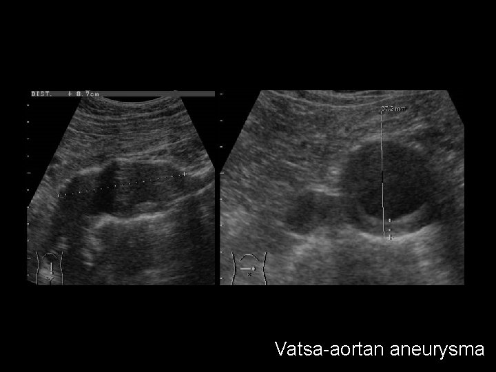 Vatsa-aortan aneurysma 
