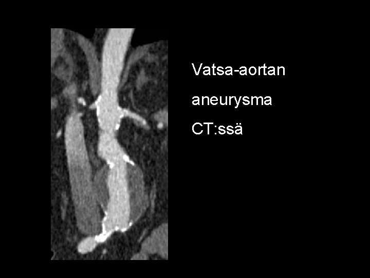 Vatsa-aortan aneurysma CT: ssä 