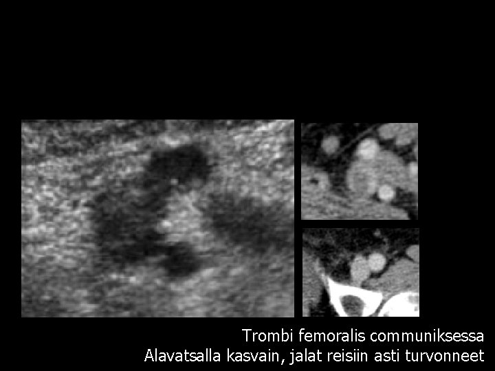 Trombi femoralis communiksessa Alavatsalla kasvain, jalat reisiin asti turvonneet 