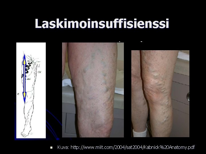 Laskimoinsuffisienssi n Kuva: http: //www. miit. com/2004/sat 2004/Kabnick%20 Anatomy. pdf 
