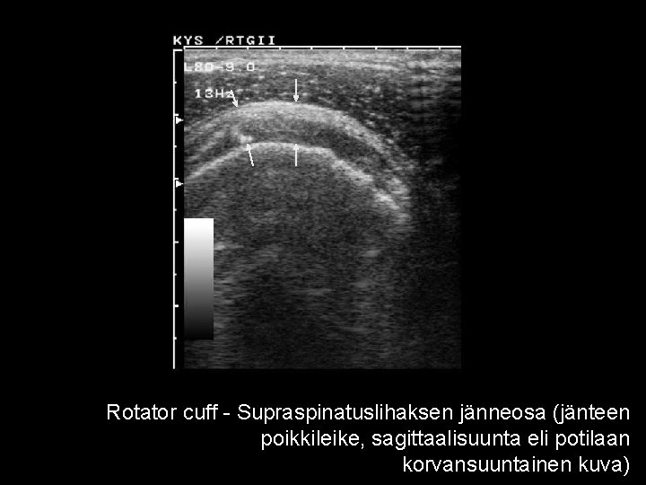 Rotator cuff - Supraspinatuslihaksen jänneosa (jänteen poikkileike, sagittaalisuunta eli potilaan korvansuuntainen kuva) 