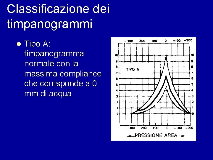 Classificazione dei timpanogrammi l Tipo A: timpanogramma normale con la massima compliance che corrisponde