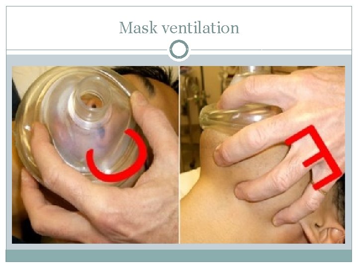 Mask ventilation 