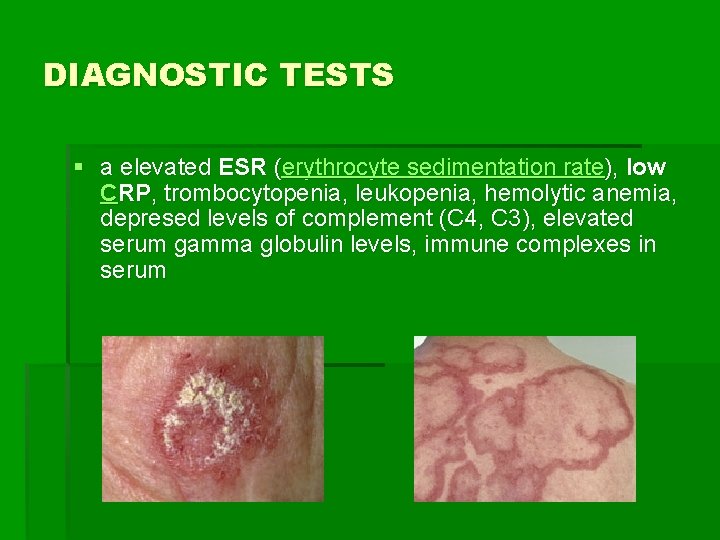 DIAGNOSTIC TESTS § a elevated ESR (erythrocyte sedimentation rate), low CRP, trombocytopenia, leukopenia, hemolytic