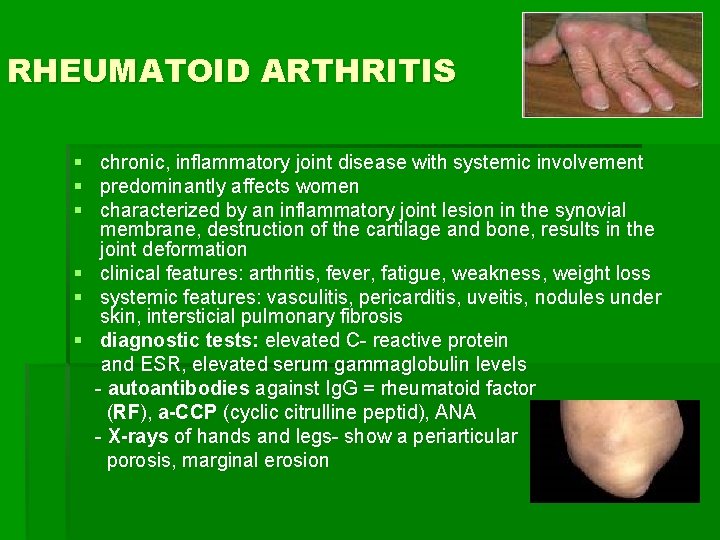 RHEUMATOID ARTHRITIS § chronic, inflammatory joint disease with systemic involvement § predominantly affects women