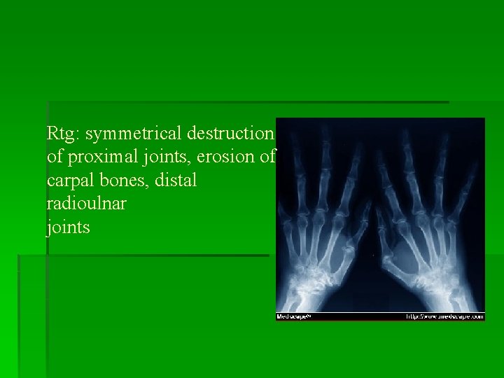 Rtg: symmetrical destruction of proximal joints, erosion of carpal bones, distal radioulnar joints 