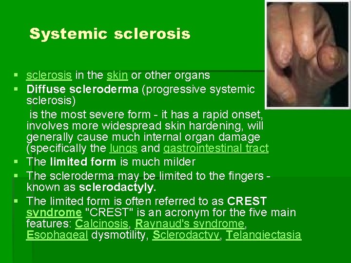 Systemic sclerosis § sclerosis in the skin or other organs § Diffuse scleroderma (progressive