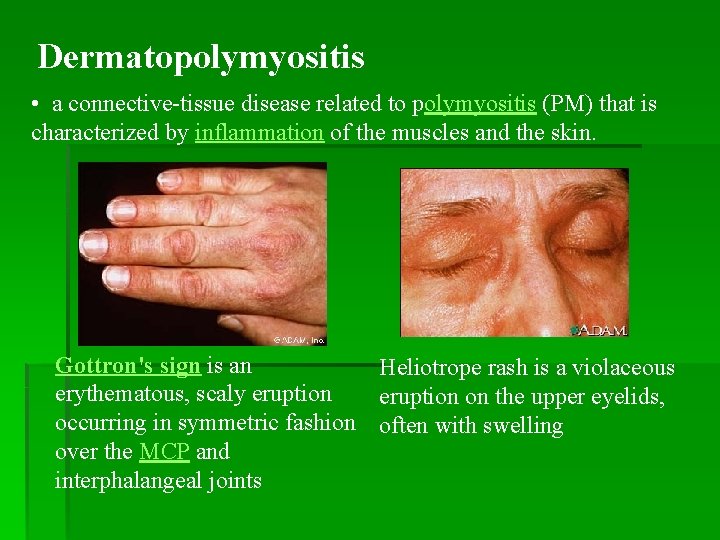 Dermatopolymyositis • a connective-tissue disease related to polymyositis (PM) that is characterized by inflammation