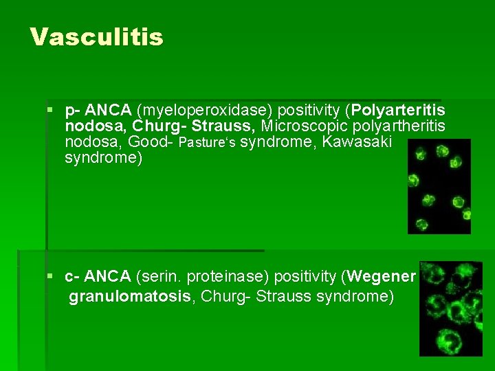 Vasculitis § p- ANCA (myeloperoxidase) positivity (Polyarteritis nodosa, Churg- Strauss, Microscopic polyartheritis nodosa, Good-