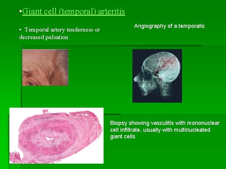  • Giant cell (temporal) arteritis • Temporal artery tenderness or decreased pulsation Angiography