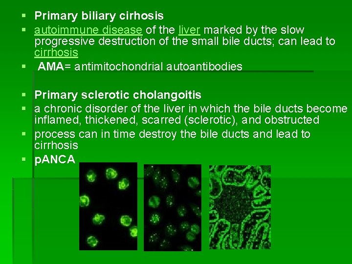 § Primary biliary cirhosis § autoimmune disease of the liver marked by the slow