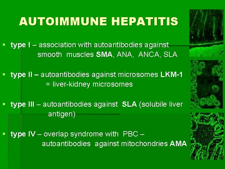 AUTOIMMUNE HEPATITIS § type I – association with autoantibodies against smooth muscles SMA, ANCA,