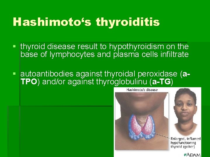 Hashimoto‘s thyroiditis § thyroid disease result to hypothyroidism on the base of lymphocytes and