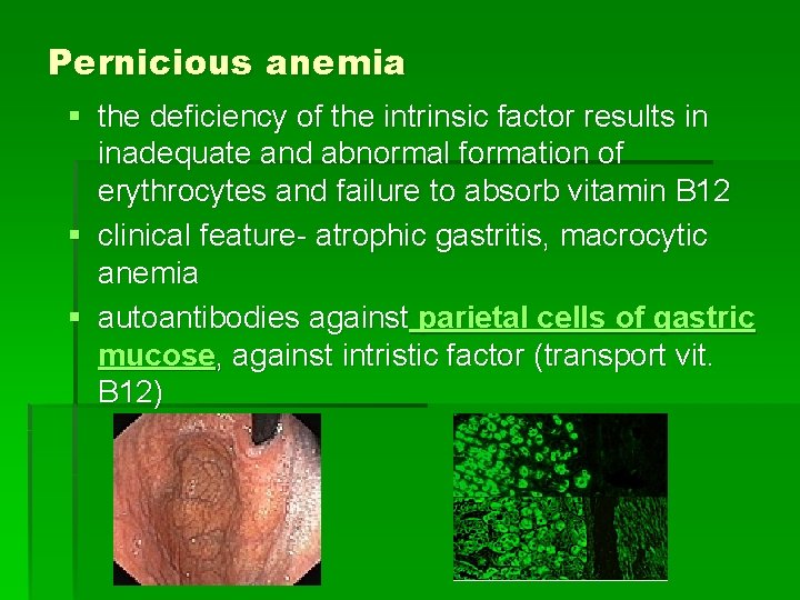 Pernicious anemia § the deficiency of the intrinsic factor results in inadequate and abnormal