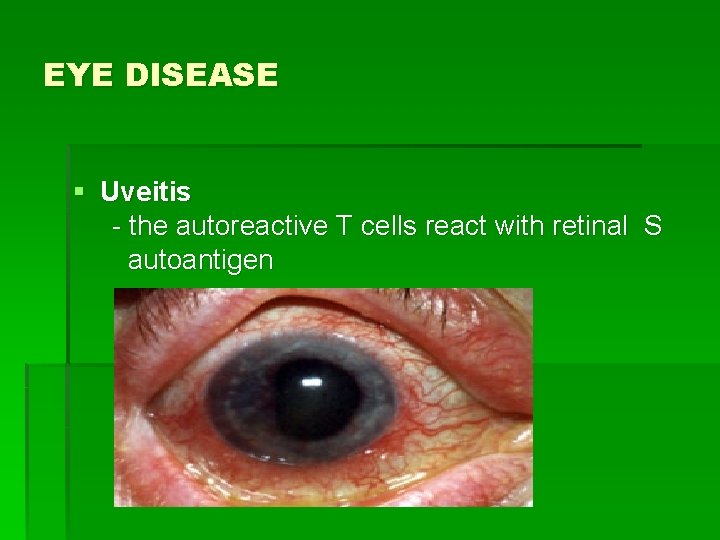 EYE DISEASE § Uveitis - the autoreactive T cells react with retinal S autoantigen