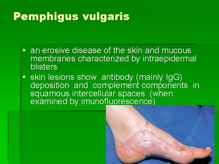 Pemphigus vulgaris § an erosive disease of the skin and mucous membranes characterized by