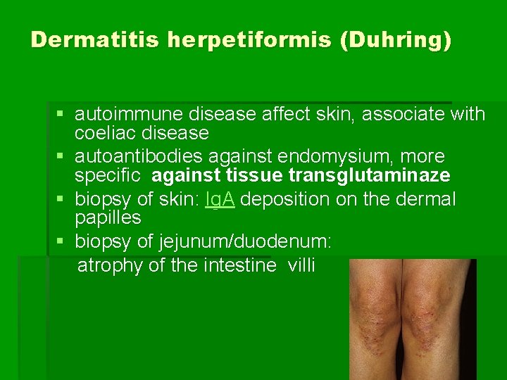 Dermatitis herpetiformis (Duhring) § autoimmune disease affect skin, associate with coeliac disease § autoantibodies