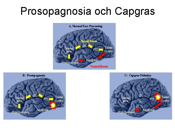 Prosopagnosia och Capgras A, Normal Face Processing Dorsal Route Cingulate gyrus Hypothalamus IPL STS Prosopagnosia och Capgras A, Normal Face Processing Dorsal Route Cingulate gyrus Hypothalamus IPL STS
