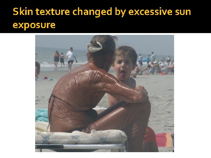 Skin texture changed by excessive sun exposure 