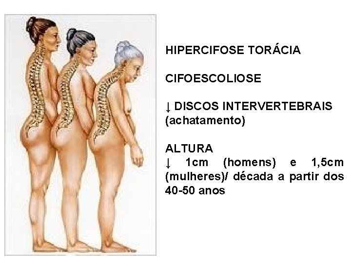 HIPERCIFOSE TORÁCIA CIFOESCOLIOSE ↓ DISCOS INTERVERTEBRAIS (achatamento) ALTURA ↓ 1 cm (homens) e 1,