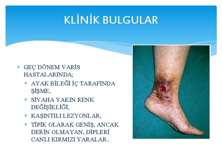 KLİNİK BULGULAR GEÇ DÖNEM VARİS HASTALARINDA; AYAK BİLEĞİ İÇ TARAFINDA ŞİŞME, SİYAHA YAKIN RENK