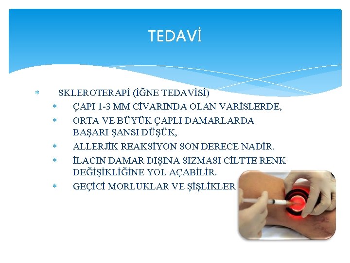 TEDAVİ SKLEROTERAPİ (İĞNE TEDAVİSİ) ÇAPI 1 -3 MM CİVARINDA OLAN VARİSLERDE, ORTA VE BÜYÜK