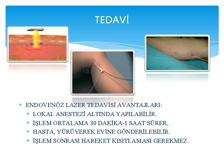 TEDAVİ ENDOVENÖZ LAZER TEDAVİSİ AVANTAJLARI: LOKAL ANESTEZİ ALTINDA YAPILABİLİR. İŞLEM ORTALAMA 30 DAKİKA-1 SAAT