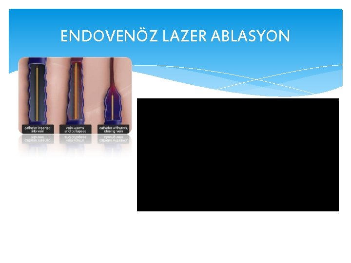 ENDOVENÖZ LAZER ABLASYON 