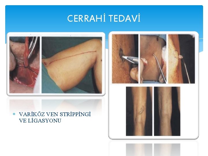 CERRAHİ TEDAVİ VARİKÖZ VEN STRİPPİNGİ VE LİGASYONU 