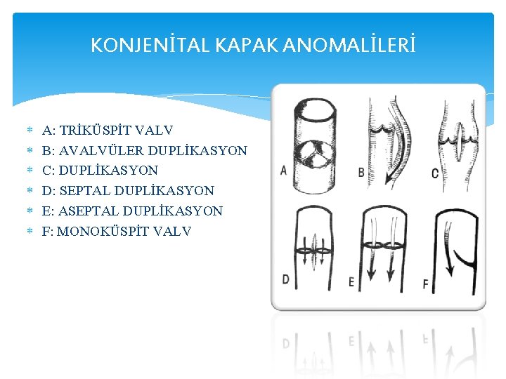 KONJENİTAL KAPAK ANOMALİLERİ A: TRİKÜSPİT VALV B: AVALVÜLER DUPLİKASYON C: DUPLİKASYON D: SEPTAL DUPLİKASYON