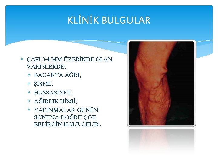 KLİNİK BULGULAR ÇAPI 3 -4 MM ÜZERİNDE OLAN VARİSLERDE; BACAKTA AĞRI, ŞİŞME, HASSASİYET, AĞIRLIK