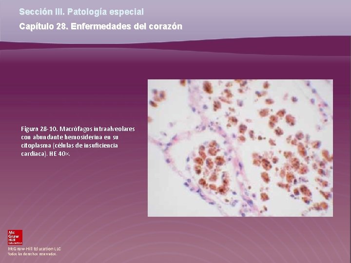 Sección III. Patología especial Capítulo 28. Enfermedades del corazón Figura 28 -10. Macrófagos intraalveolares