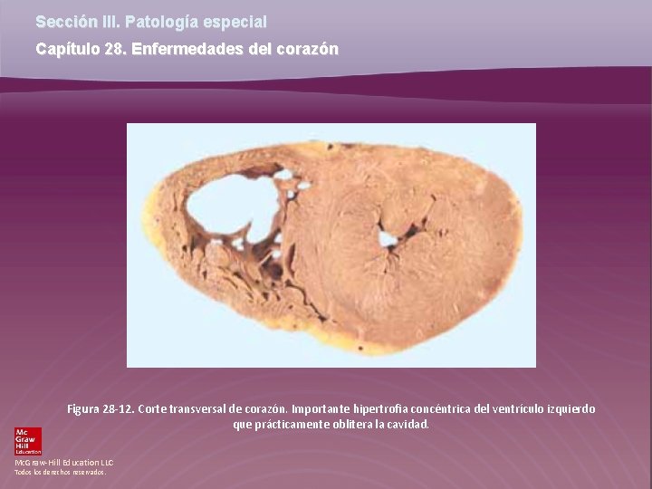 Sección III. Patología especial Capítulo 28. Enfermedades del corazón Figura 28 -12. Corte transversal