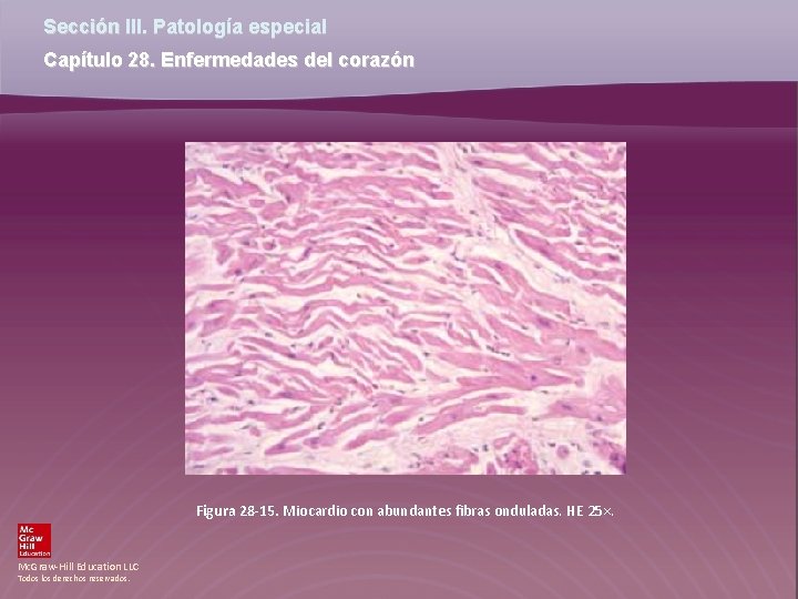 Sección III. Patología especial Capítulo 28. Enfermedades del corazón Figura 28 -15. Miocardio con