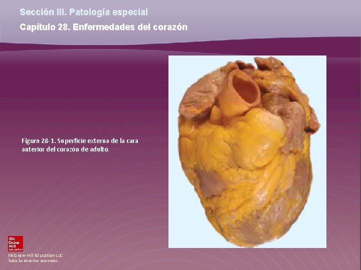 Sección III. Patología especial Capítulo 28. Enfermedades del corazón Figura 28 -1. Superficie externa