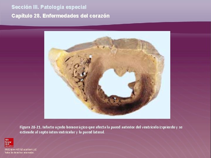 Sección III. Patología especial Capítulo 28. Enfermedades del corazón Figura 28 -21. Infarto agudo