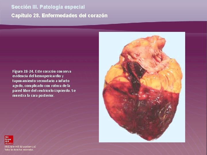 Sección III. Patología especial Capítulo 28. Enfermedades del corazón Figura 28 -24. Este corazón