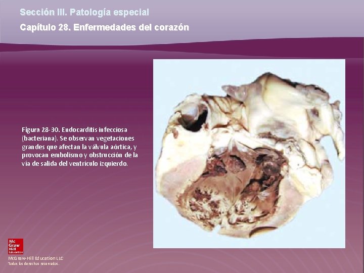 Sección III. Patología especial Capítulo 28. Enfermedades del corazón Figura 28 -30. Endocarditis infecciosa