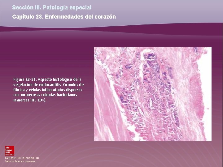 Sección III. Patología especial Capítulo 28. Enfermedades del corazón Figura 28 -31. Aspecto histológico