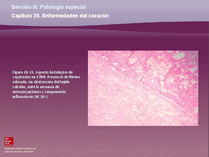 Sección III. Patología especial Capítulo 28. Enfermedades del corazón Figura 28 -33. Aspecto histológico