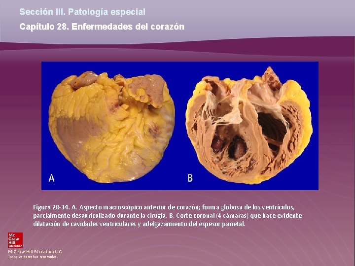 Sección III. Patología especial Capítulo 28. Enfermedades del corazón Figura 28 -34. A. Aspecto