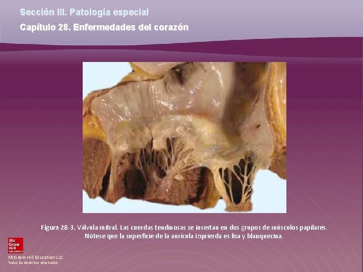 Sección III. Patología especial Capítulo 28. Enfermedades del corazón Figura 28 -3. Válvula mitral.