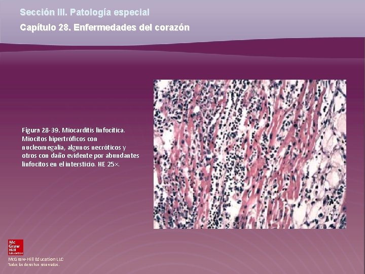 Sección III. Patología especial Capítulo 28. Enfermedades del corazón Figura 28 -39. Miocarditis linfocítica.