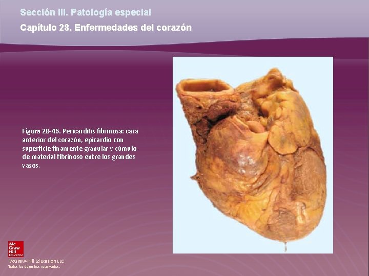 Sección III. Patología especial Capítulo 28. Enfermedades del corazón Figura 28 -46. Pericarditis fibrinosa: