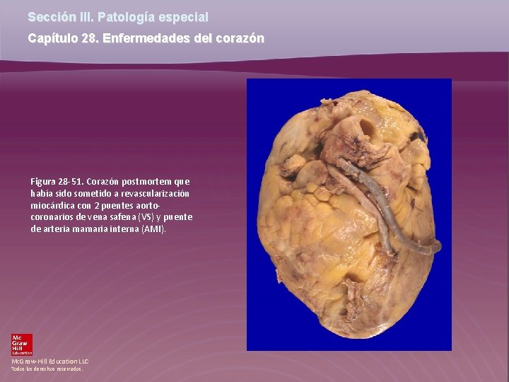 Sección III. Patología especial Capítulo 28. Enfermedades del corazón Figura 28 -51. Corazón postmortem