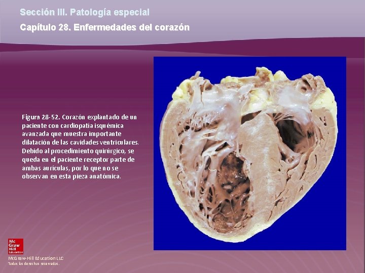 Sección III. Patología especial Capítulo 28. Enfermedades del corazón Figura 28 -52. Corazón explantado