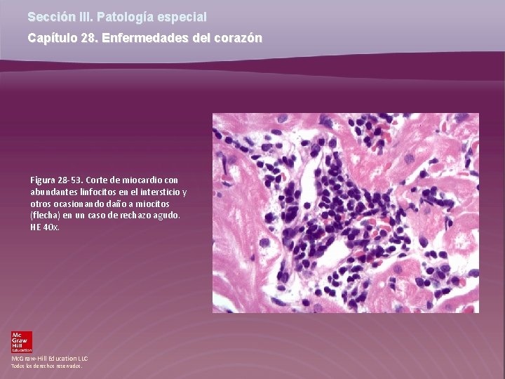 Sección III. Patología especial Capítulo 28. Enfermedades del corazón Figura 28 -53. Corte de