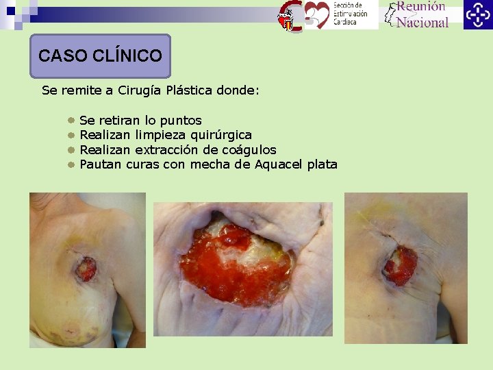 CASO CLÍNICO Se remite a Cirugía Plástica donde: Se retiran lo puntos Realizan limpieza